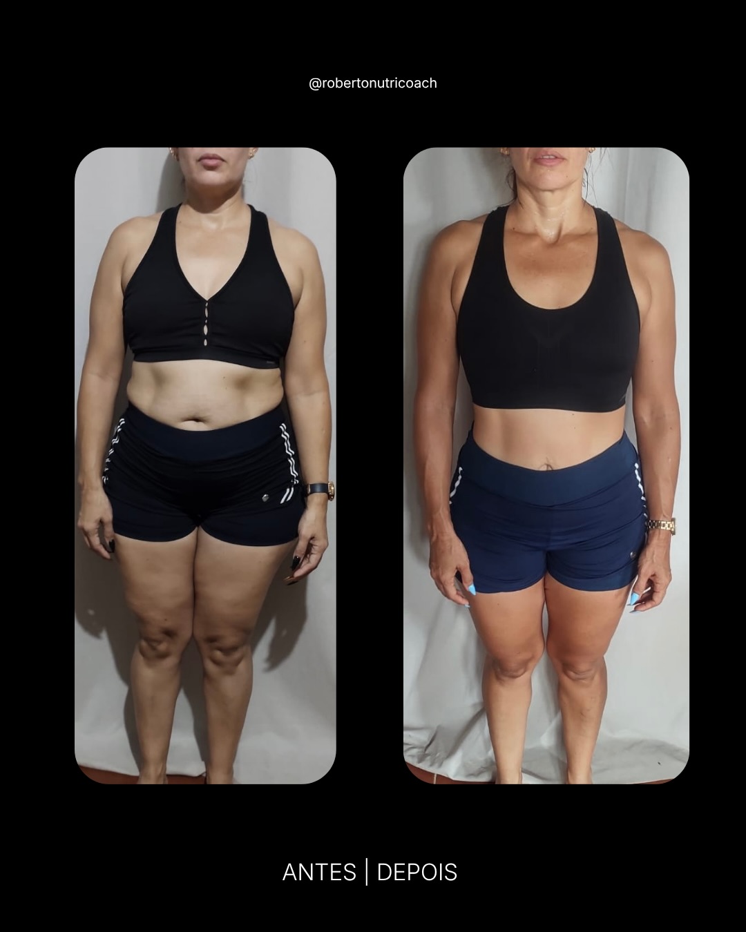 Paciente M.B. — Perda de gordura + tônus